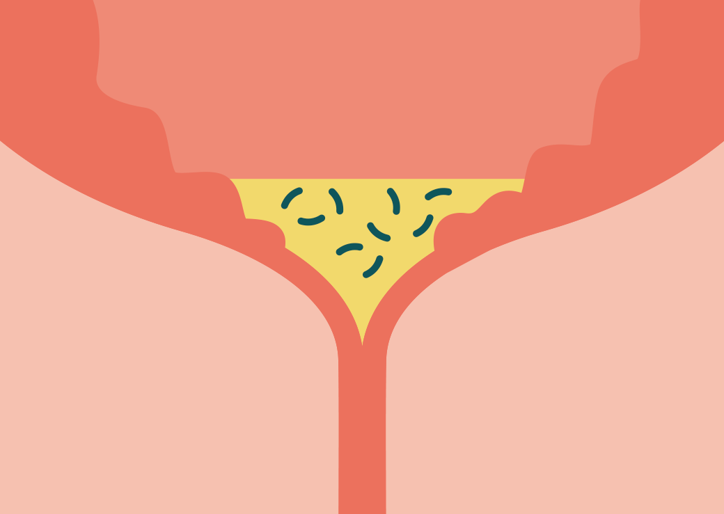 Was ist der Zusammenhang zwischen Restharn und Harnwegsinfektionen?