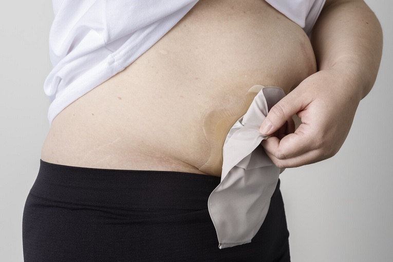 Erfahrungsberichte aus der Praxis | SenSura® Mio Konkav