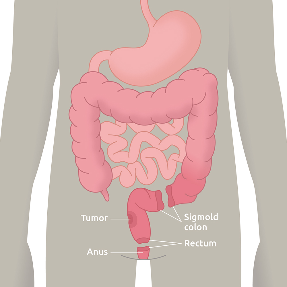 Low anterior resection syndrom (LARS)