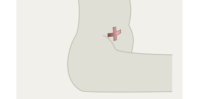 Stomamarkierung im Sitzen