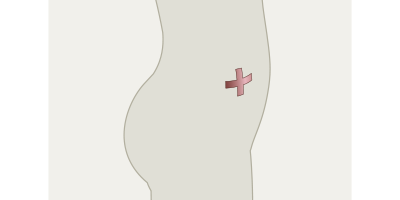 Stomamarkierung im Stehen