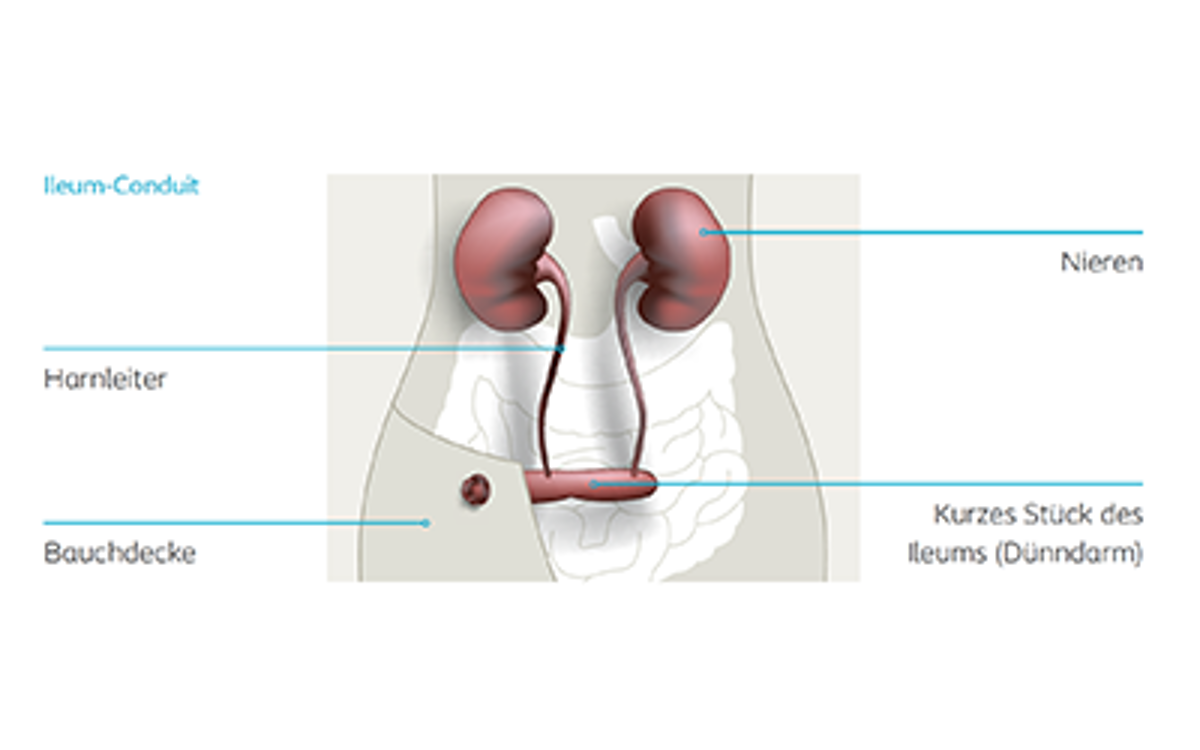 Illustration Ileum-Conduit mit Beschriftungen