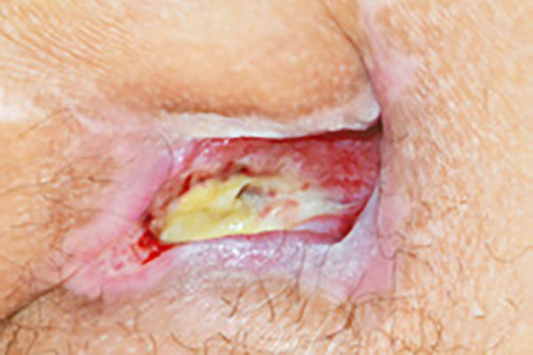 Dekubitus Tag 0