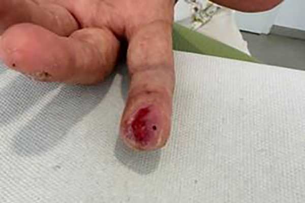 Schnittwunde am Finger Tag 22