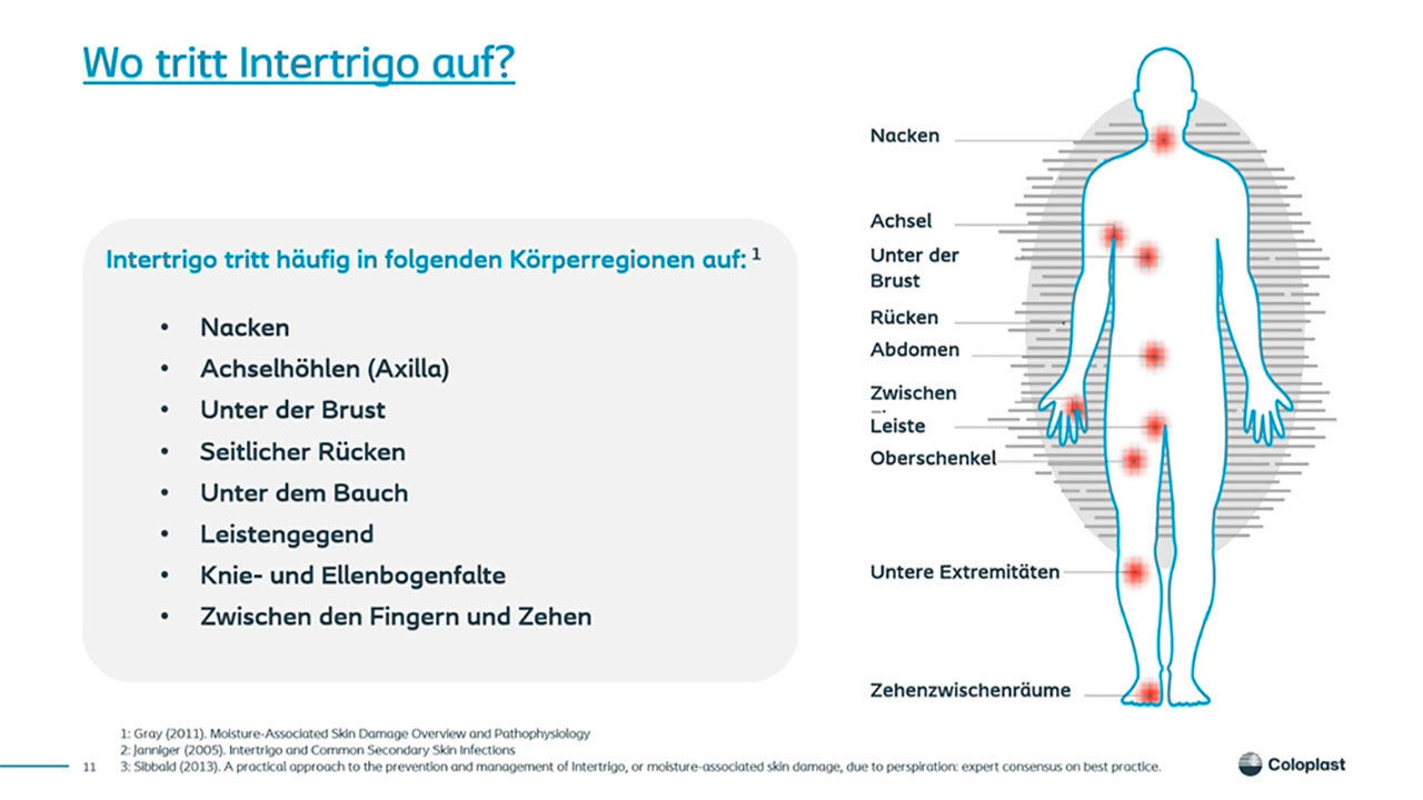 Teaser: Augen auf: Intertrigo oder IAD