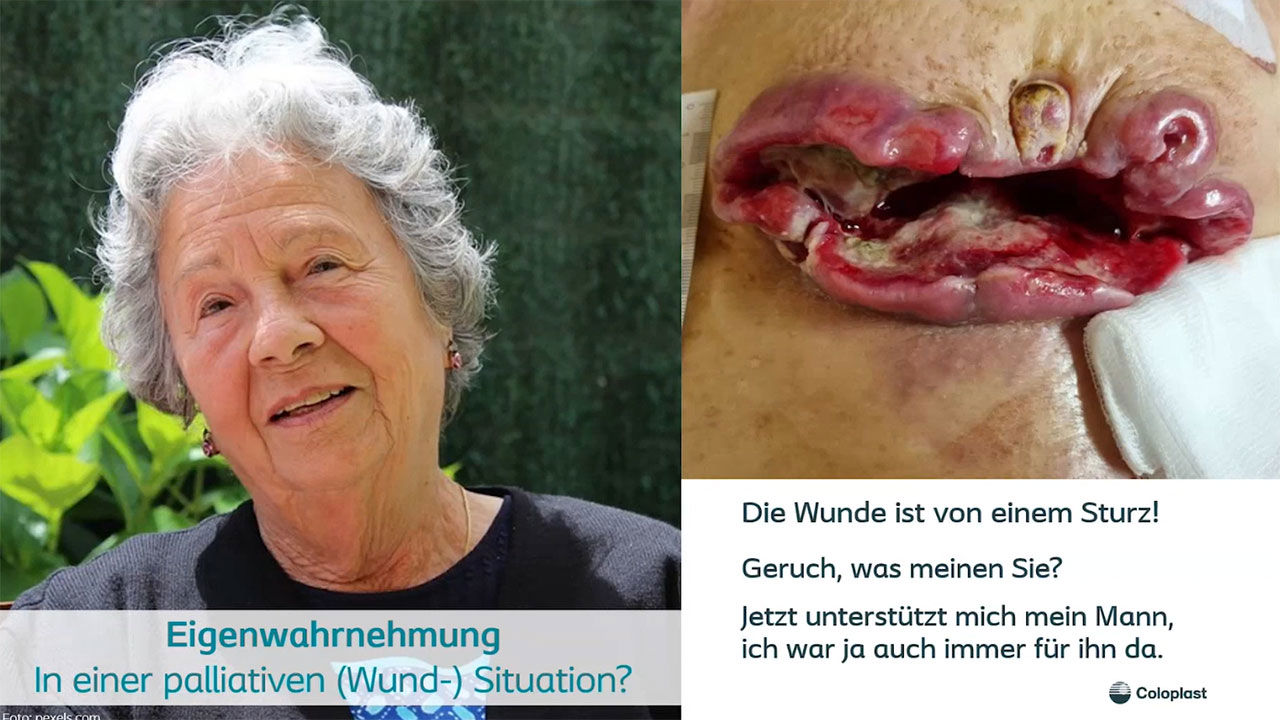Teaser: Wundversorgung in der Palliativmedizin